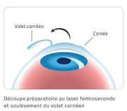 Découpe préparatoire du volet cornéen 